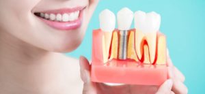 dental implants Essex